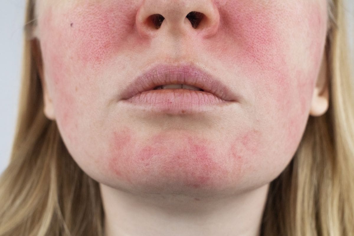 Biểu hiện viêm da Demodex