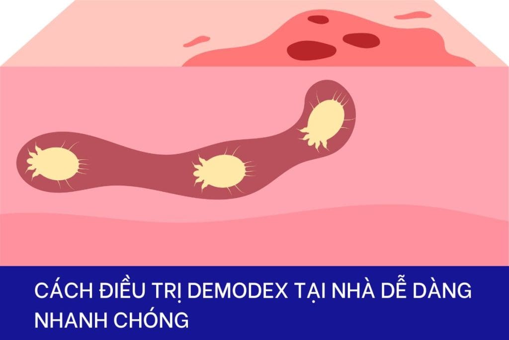 Cách điều trị Demodex tại nhà dễ dàng