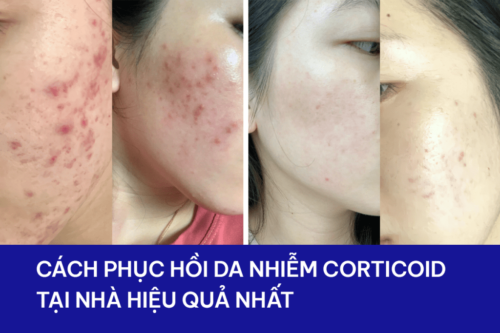 Cách phục hồi da nhiễm Corticoid tại nhà