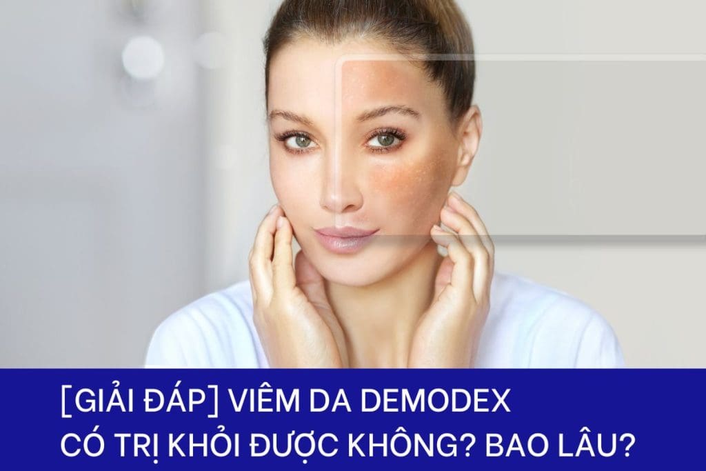 Viêm da Demodex có chữa khỏi không và mất bao lâu