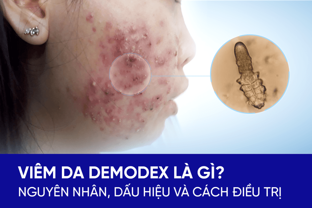 Nguyên nhân, dấu hiệu nhận biết và cách điều trị viêm da Demodex