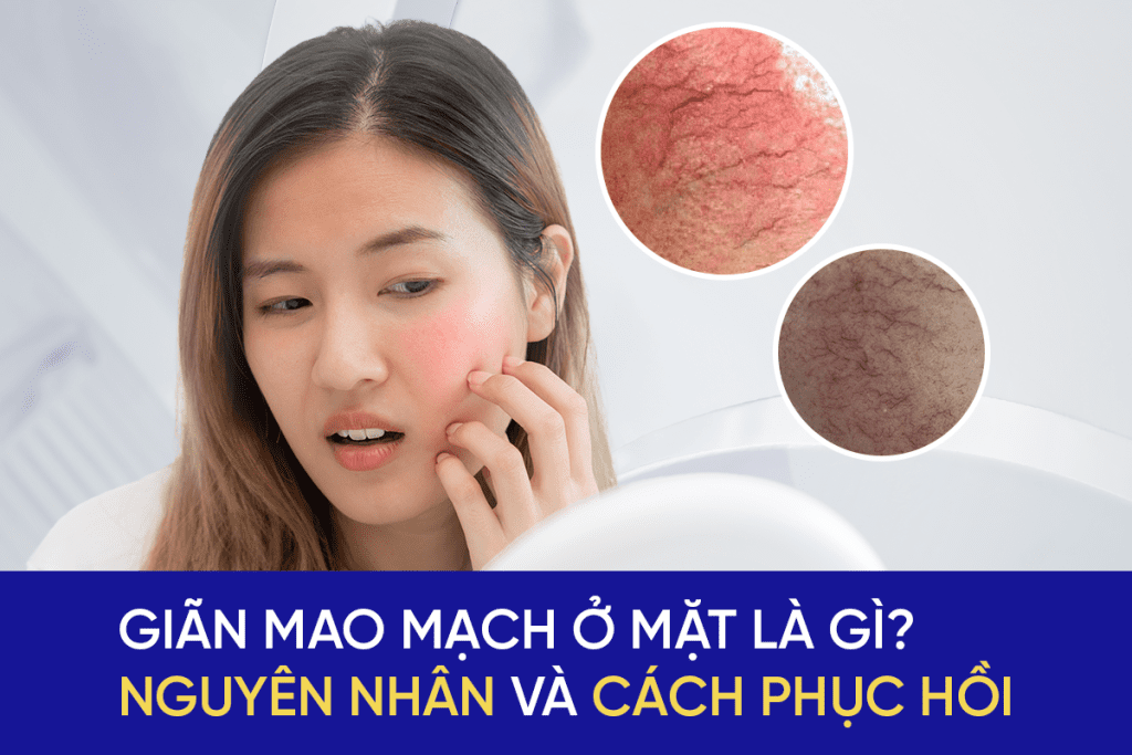 Giãn mao mạch ở mặt là gì?
