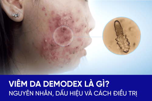 Nguyên nhân, dấu hiệu nhận biết và cách điều trị viêm da Demodex